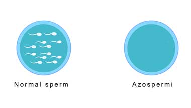 Azospermy