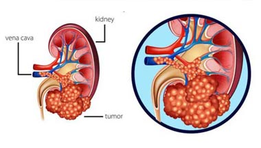 Kidney Cancer