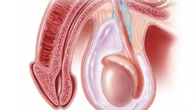 Hydrocele