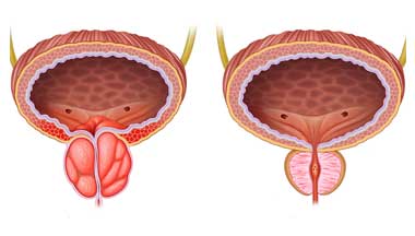 Uretheral Stricture